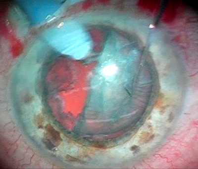 болит глаз после операции катаракта