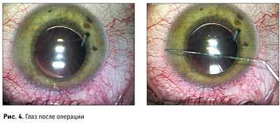 глаз после операции катаракты красный