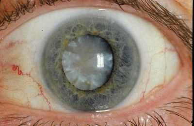 катаракта ограничения после операции