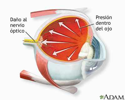 отек роговицы после операции катаракты лечение