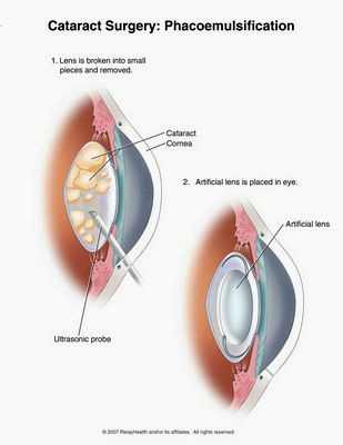 операция катаракты при диабете