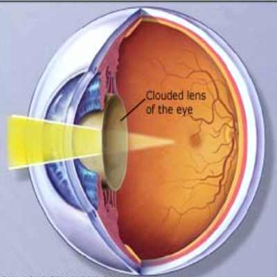 развитие катаракты при диабете