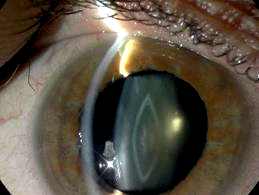 катаракта лечение цена в воронеже