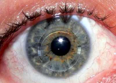 катаракта симптомы и лечение цена операции в кемерово