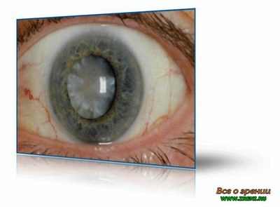 катаракта этиология патогенез клиника лечение