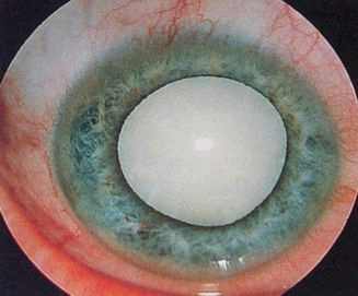 перезрелая катаракта клиника