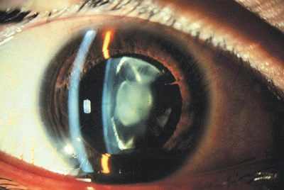травматическая катаракта клиника