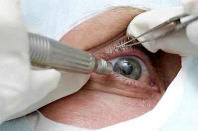 лечение катаракты ультразвуком