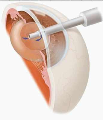ультразвуковая факоэмульсификация катаракты