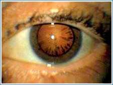 возрастная катаракта диагностика