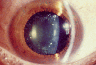что такое врожденная катаракта глаза