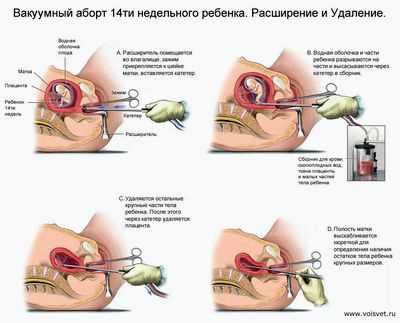 форум форумок врожденная катаракта