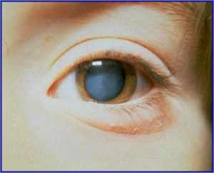 врожденная катаракта глаза