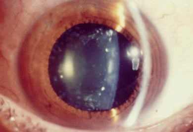 врожденная катаракта у детей фото