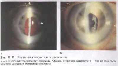 дисцизия вторичной катаракты