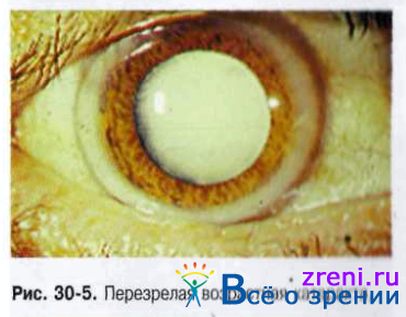 вторичная катаракта шары эльшнига
