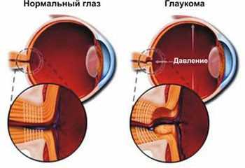 Глаукома