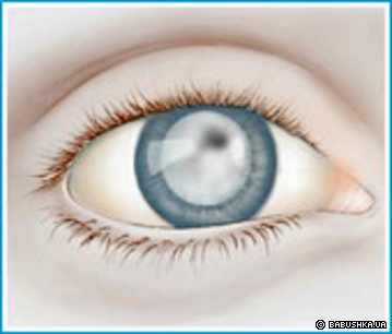 катаракта операция ижевск