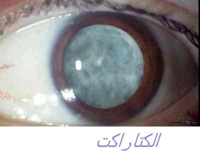 катаракта операция ставрополь