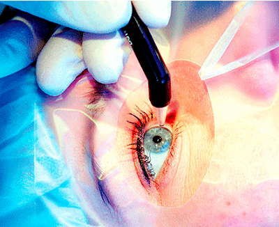 сколько стоит операция катаракта в оренбурге