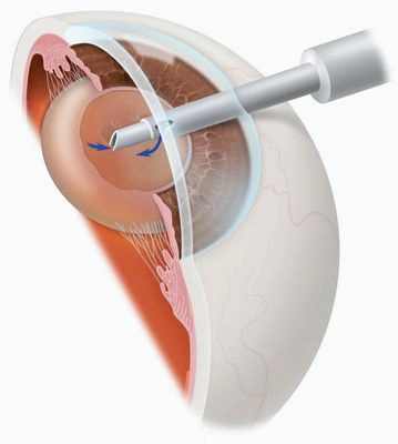 экстракапсулярная экстракция катаракты с имплантацией иол видео