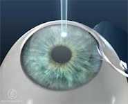 Исследование показало удаление катаракты лазером более безопасно