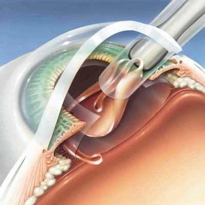факоэмульсификация катаракты с имплантацией аккомодирующей интраокулярной линзы