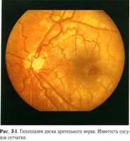 Гипоплазия зрительного нерва. Гипотония глазного яблока. Главная страница.