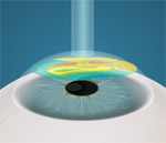 лазерная коррекция зрения по методике супер ласик
