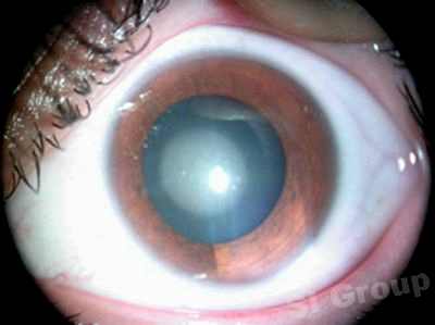 катаракта лазерная операция отзывы