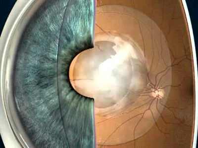 вторичная катаракта лечение лазером