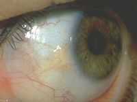 Пигментный ретинит с нарушениями обмена липидов. Пингвекула. Питание для наших глаз.