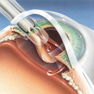 хирургическое лечение катаракты видео