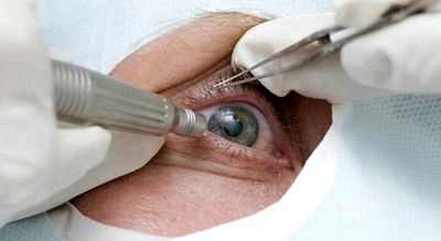 хирургическое лечение катаракты