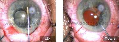 начальная осложненная катаракта