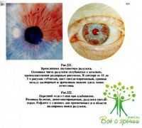 Метастазирование опухолей увеального тракта глаза. Метод зрительного переобучения. Методика биомикроскопического исследования.