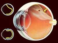 Отслойка стекловидного тела (мушки и молнии). Офисная болезнь, или Береги зрение смолоду. Офтальмологические операции.