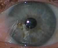 Отслойка стекловидного тела (мушки и молнии). Офисная болезнь, или Береги зрение смолоду. Офтальмологические операции.