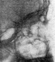Рентгенодиагностика заболеваний лобной пазухи. Рентгенодиагностика заболеваний основной пазухи. Рентгенодиагностика заболеваний решетчатого лабиринта.