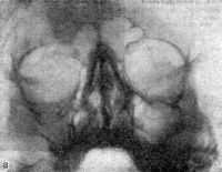 Рентгенодиагностика заболеваний лобной пазухи. Рентгенодиагностика заболеваний основной пазухи. Рентгенодиагностика заболеваний решетчатого лабиринта.