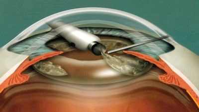 искусственный хрусталик при катаракте