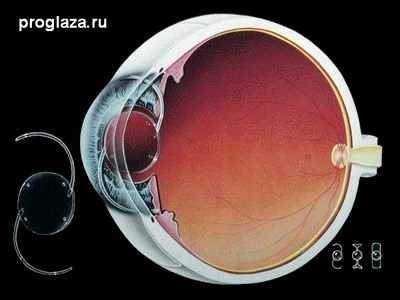 катаракта классификация лечения