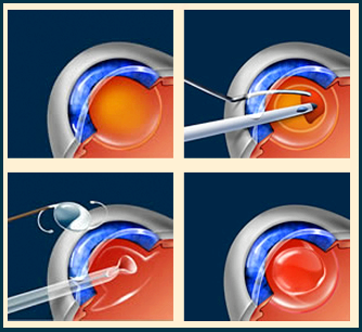 профилактика и лечение катаракты