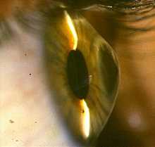 Глаза с кератоконусом, в отличие от здоровых, характеризуются большей асимметрией параметров роговицы