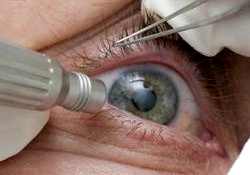 катаракта и сахарный диабет операция