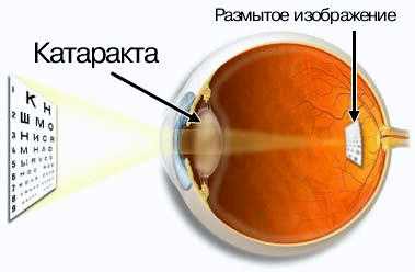 диагностика катаракты картинки