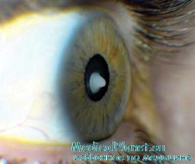 диагностика врожденной катаракты