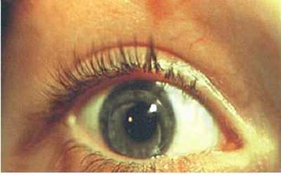 врожденная катаракта левого глаза