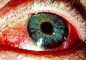 Синдром красных глаз