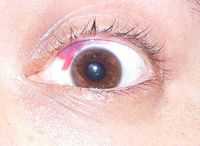 Повреждение глаза и его придатков у детей и взрослых. . Повреждения (травмы) глаз (II). Повреждения глаз.